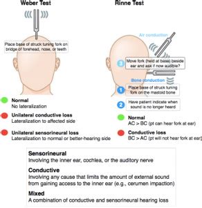 weber test cerumen impaction|cerumen impaction treatment.